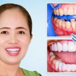 2 Phương pháp hô biến hàm răng không đều